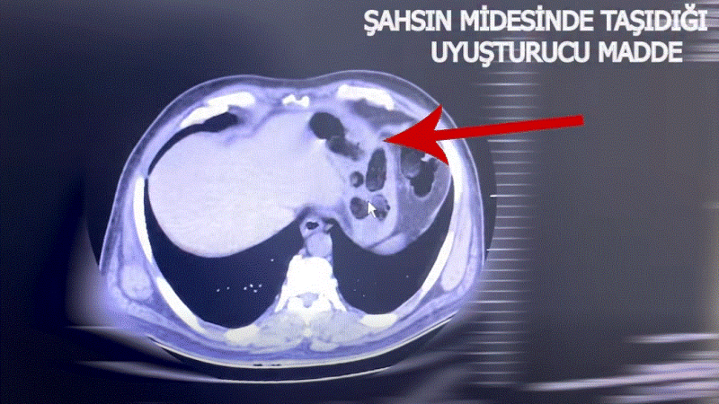 MİDESİNDE 160 PARÇA UYUŞTURUCUYLA YAKALANDI