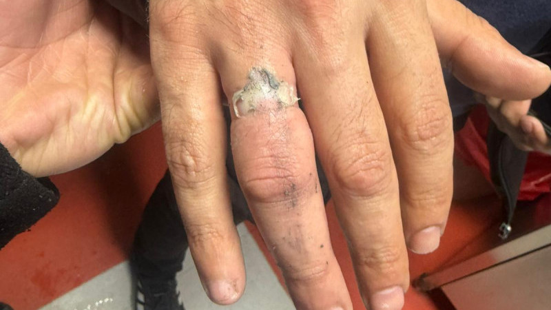 PARMAĞINA SIKIŞAN YÜZÜK İTFAİYE EKİPLERİNCE ÇIKARILDI